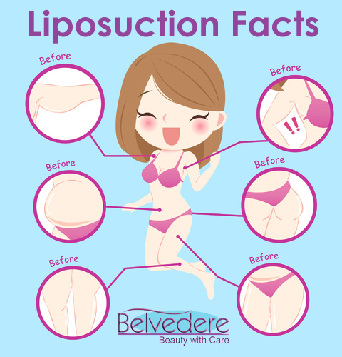 Liposuction - Fat Removal Surgery