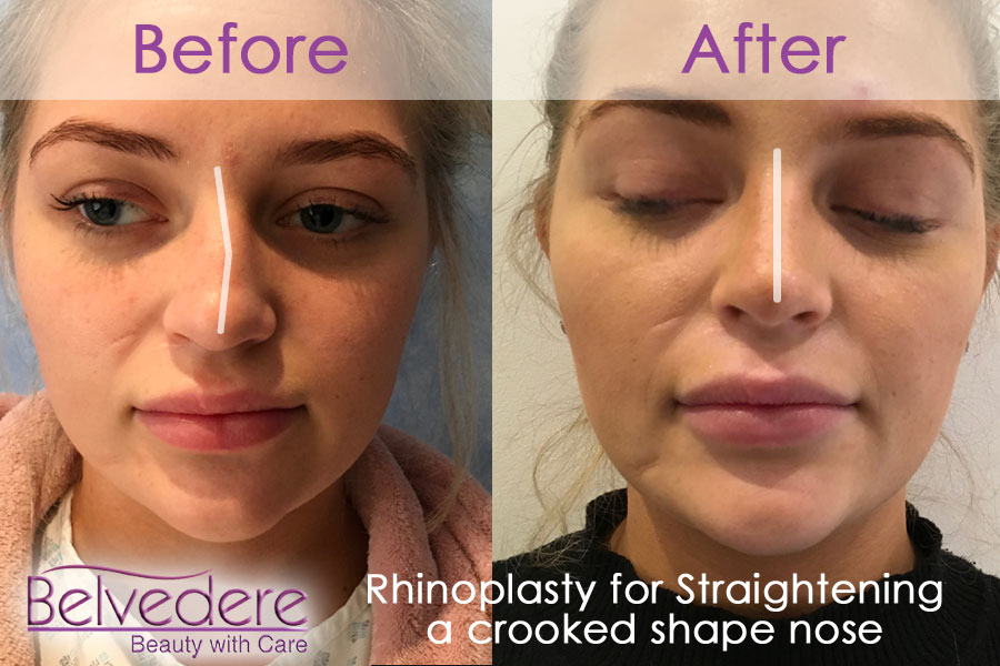 Rhinoplasty - Nose Reshaping surgery